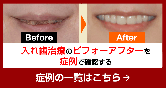 入れ歯治療のビフォーアフターを、症例で確認する
