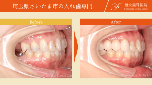 「入れ歯」と分かりにくい入れ歯は作れますか？機能・審美を共に取り戻す入れ歯（30代女性）