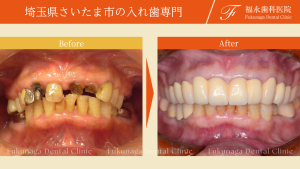 歯医者さんは怖いから歯がボロボロでもいい。 その位、歯科治療は怖いけど入れ歯は作れますか？（70代女性）