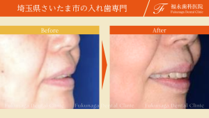入れ歯安定剤を使わなくてもいい総入れ歯
